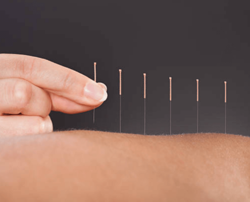 Akupunktur og stofskifte